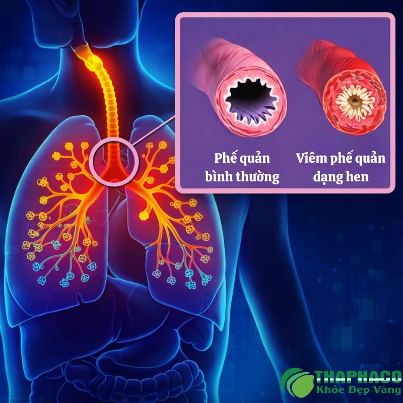 Hen phế quản mạn, hay còn gọi là hen suyễn mạn tính