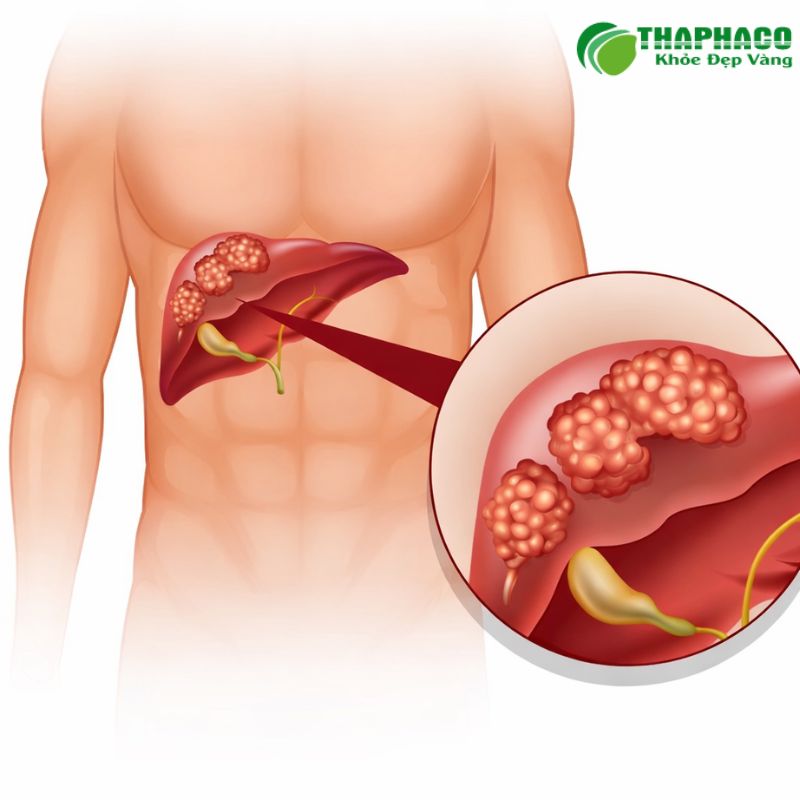 Triệu chứng nhận biết nang gan và khi nào cần thăm khám