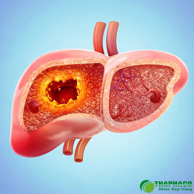 Triệu chứng nhận biết nang gan và khi nào cần thăm khám