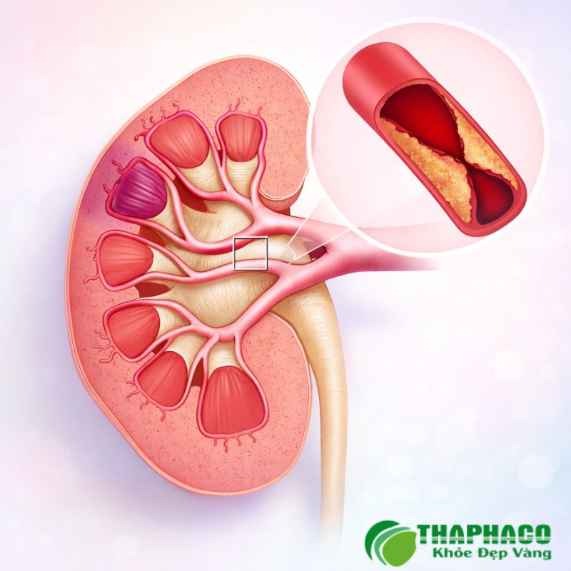 Nhồi máu thận bắt nguồn từ nhiều yếu tố như bệnh tim mạch (rung nhĩ, van tim)