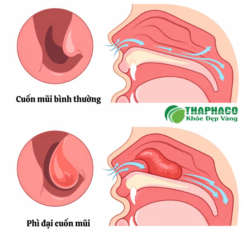 phì đại cuốn mũi là bệnh gì