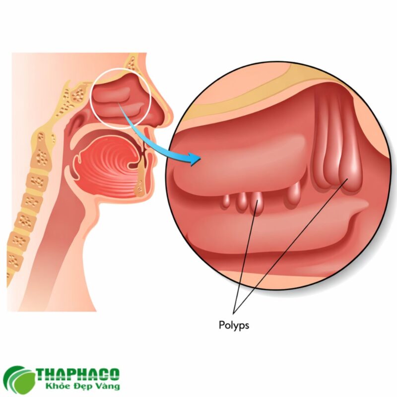 Polyp mũi là khối u lành tính phát triển từ niêm mạc mũi hoặc xoang