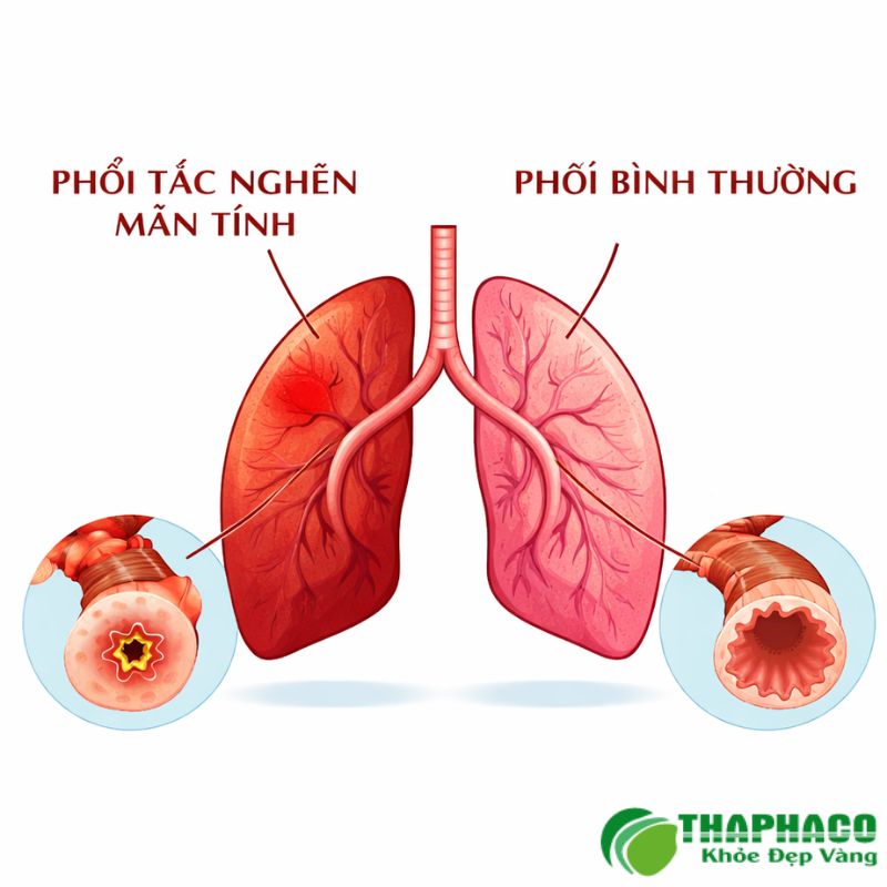 tắc nghẽn phổi mãn tính là gì