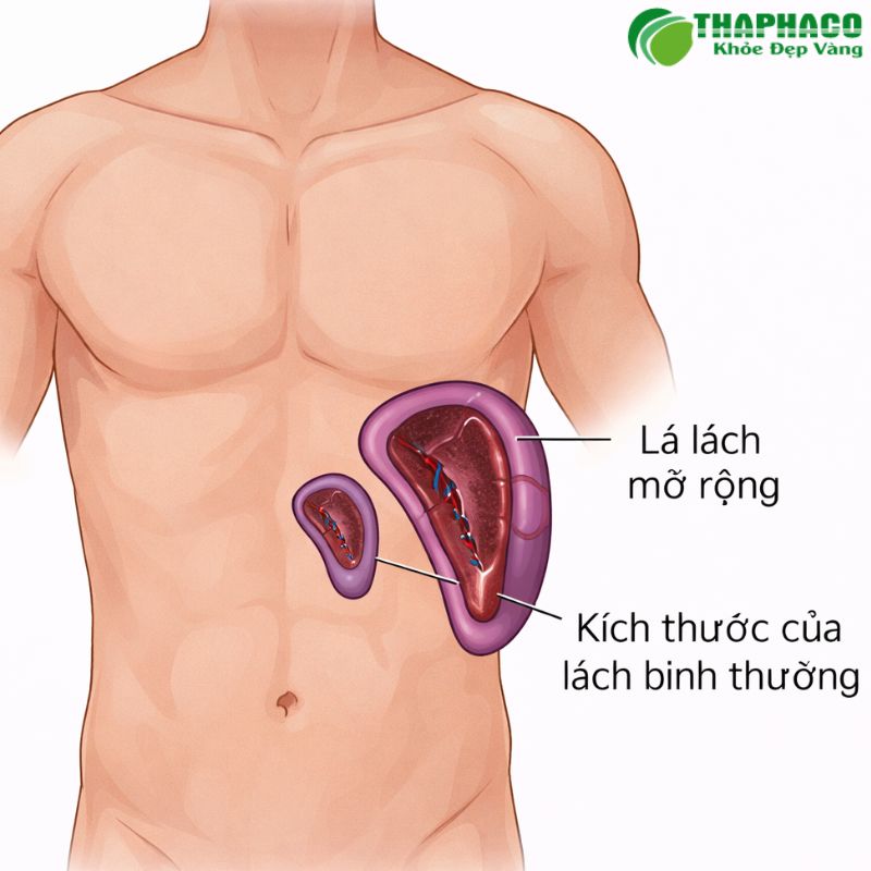 Dấu Hiệu Nhận Biết Và Biến Chứng Nguy Hiểm Của Tăng Áp Lực Tĩnh Mạch Cửa