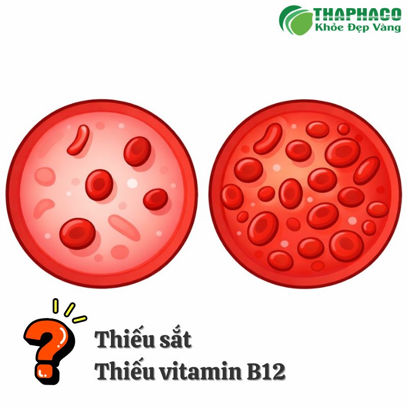 thiếu sắt thiếu vitamin b12 là bị gì