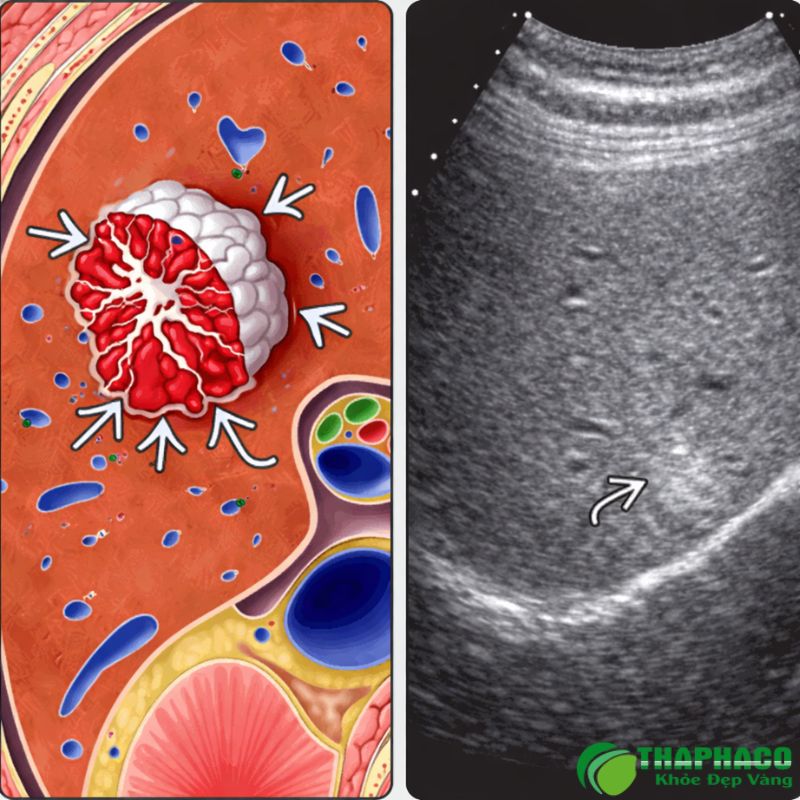 Triệu Chứng, Chẩn Đoán và Khi Nào Cần Lo Lắng Về U Máu Gan