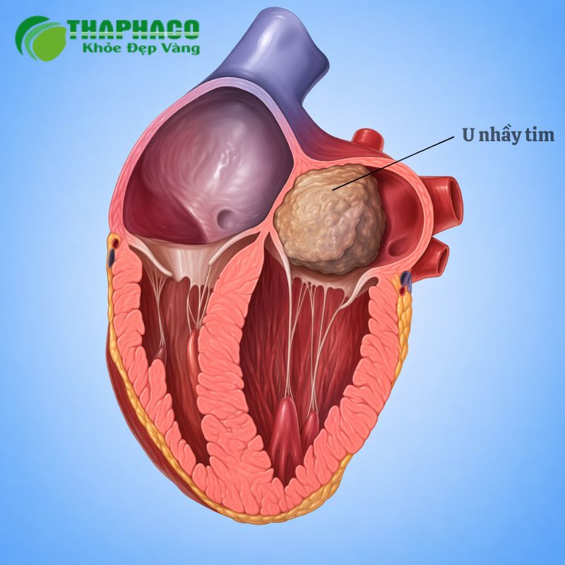 U nhầy tim là khối u lành tính phổ biến nhất trong tim, thường xuất hiện ở tâm nhĩ trái
