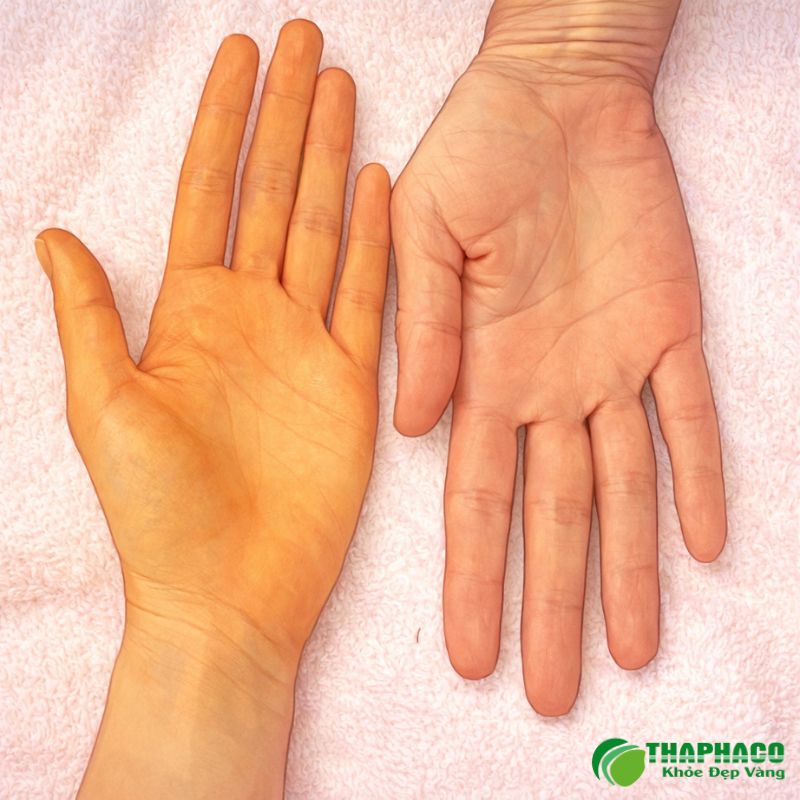 vàng da do rối loạn chuyển hoá là gì