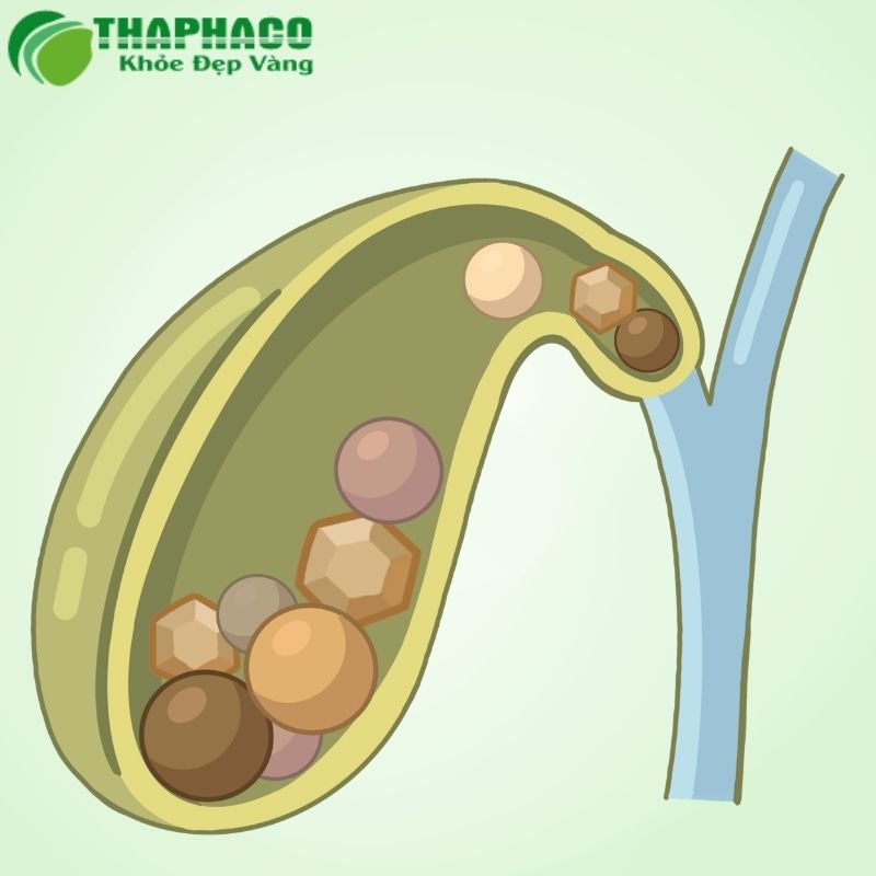 Để phòng ngừa viêm đường mật, tôi khuyên quý vị nên duy trì chế độ ăn uống lành mạnh