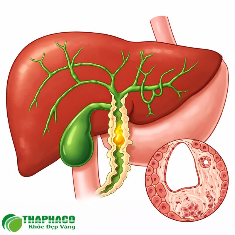 Viêm đường mật do vi khuẩn có thể dẫn đến các biến chứng nghiêm trọng