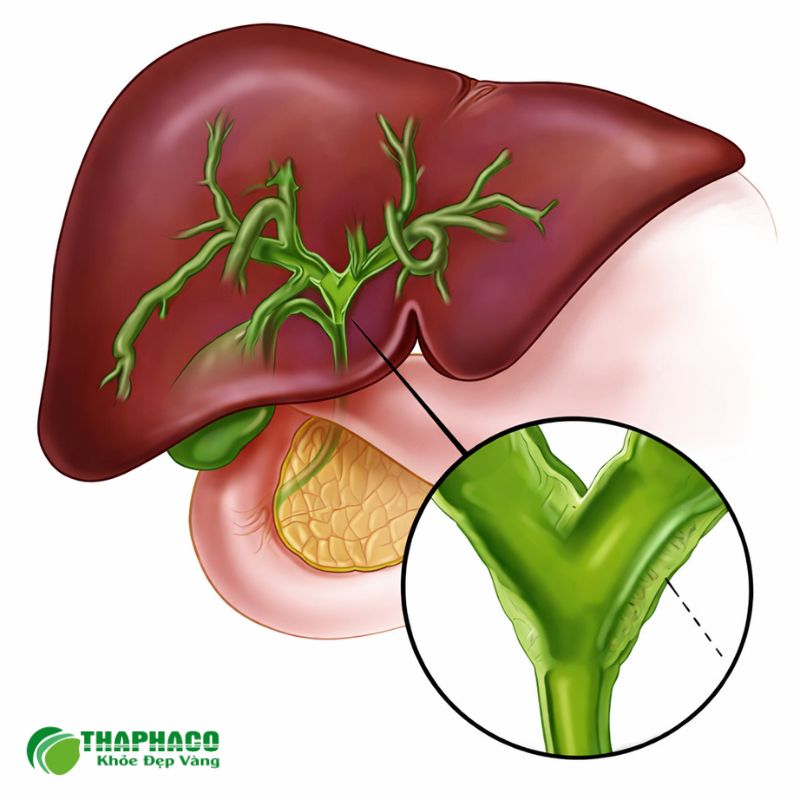 Viêm gan do vi khuẩn là tình trạng viêm nhiễm tại gan gây ra bởi các chủng vi khuẩn