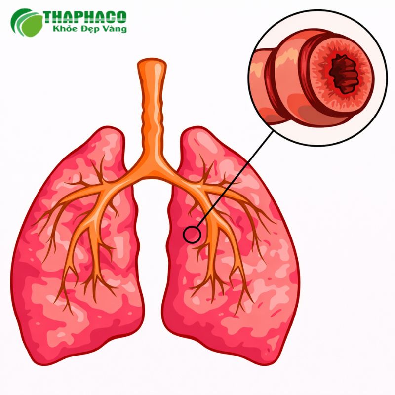 viêm phế quản cấp là gì