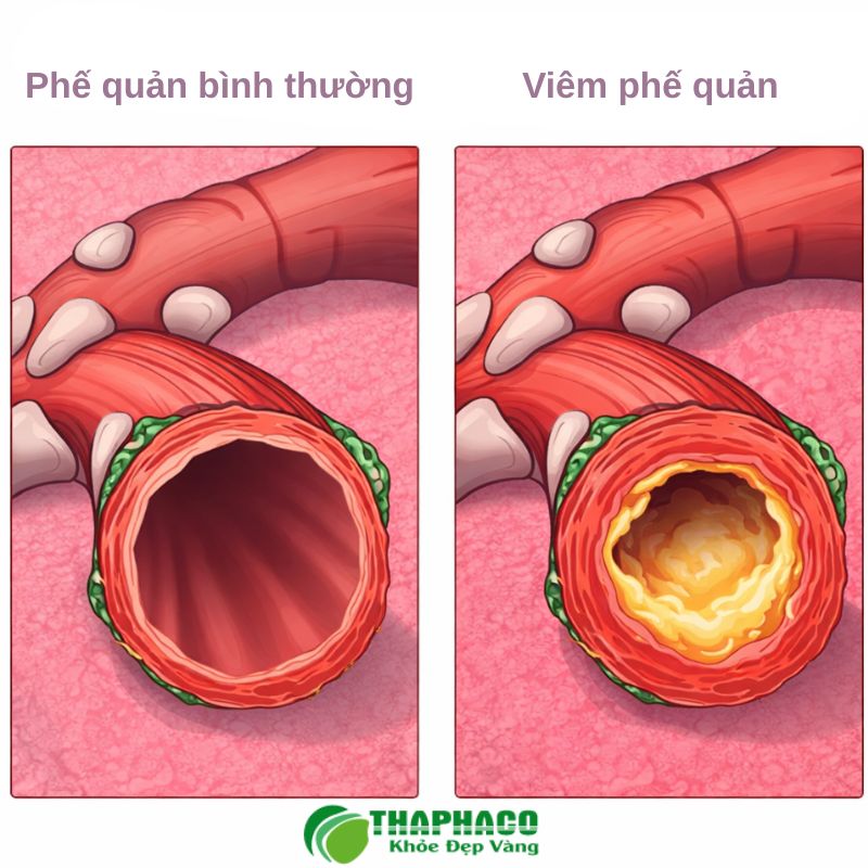 Viêm phế quản mạn khác gì viêm phế quản cấp