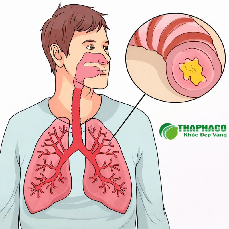 Bài thuốc sắc hỗ trợ viêm phế quản mạn