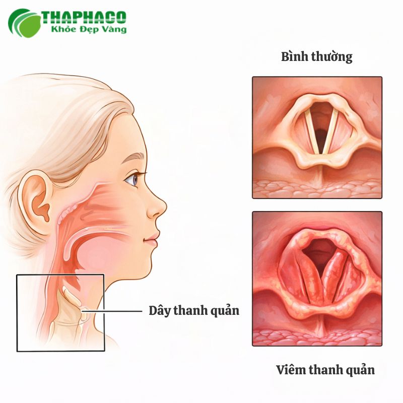 Viêm thanh quản là tình trạng viêm nhiễm ở dây thanh âm, gây sưng tấy và kích ứng