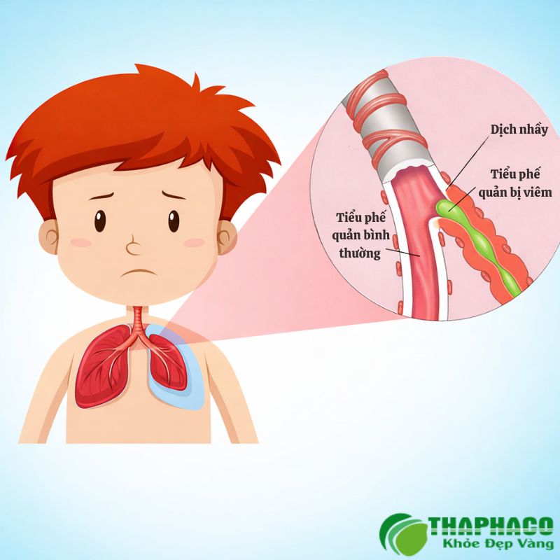 viêm tiểu phế quản là gì