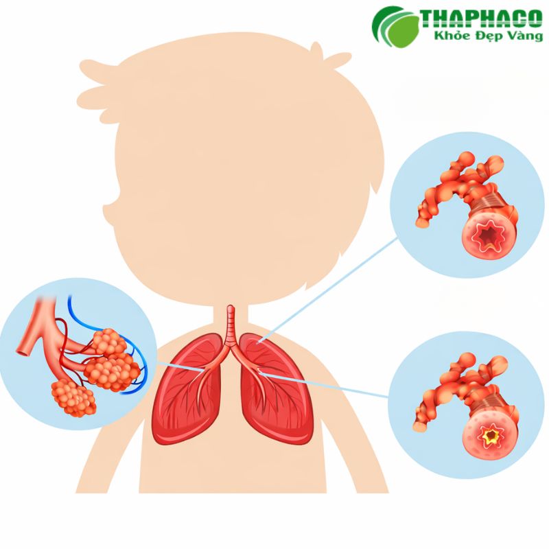 Dấu hiệu nhận biết Viêm tiểu phế quản ở trẻ em 