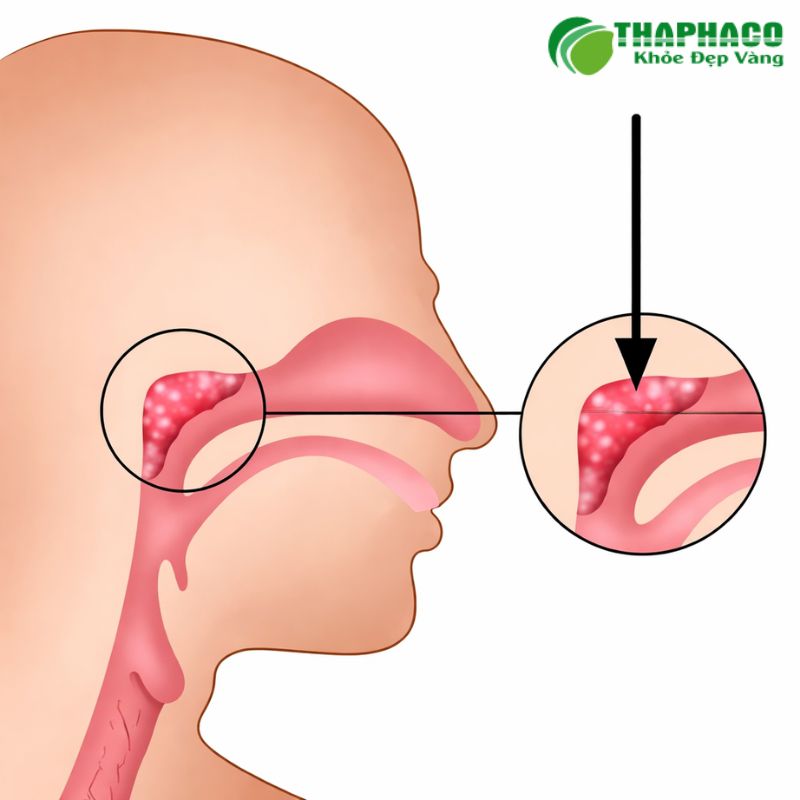 Viêm VA ở trẻ em có thể do nhiều nguyên nhân, chủ yếu là nhiễm virus, vi khuẩn