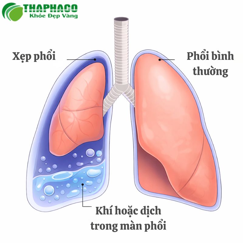 Xẹp phổi là gì