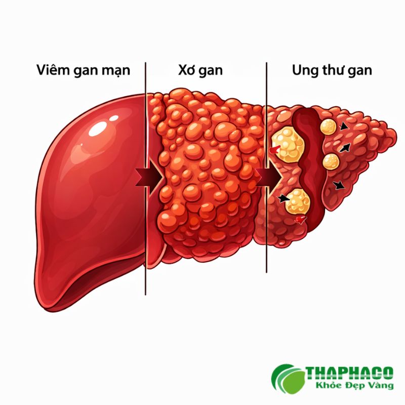 Xơ gan là tình trạng tổn thương gan mãn tính, các tế bào gan bị phá hủy