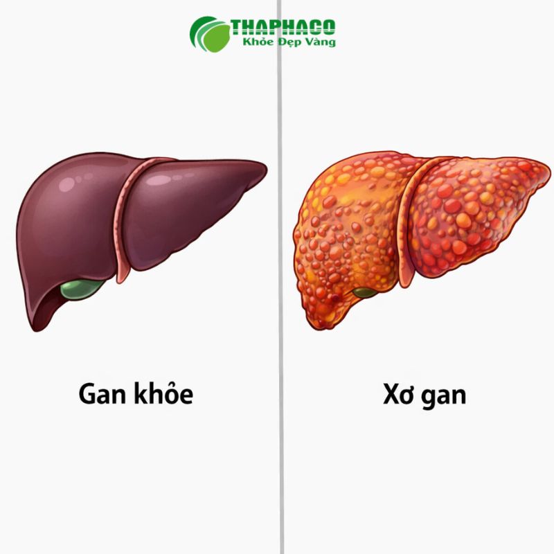 Gan nhiễm mỡ không do rượu, đặc biệt là thể viêm gan nhiễm mỡ (NASH)