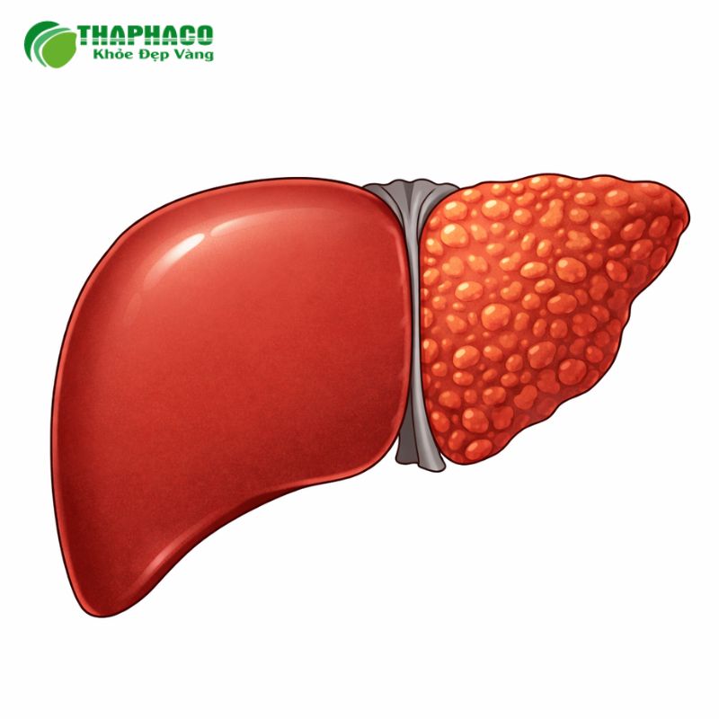 Vai trò của chế độ ăn uống và lối sống trong quản lý xơ gan