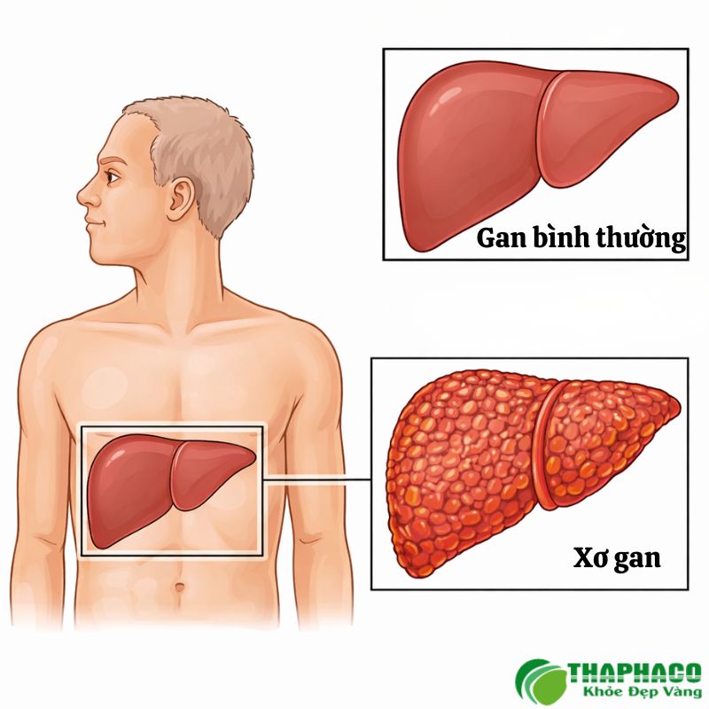xơ gan là gì