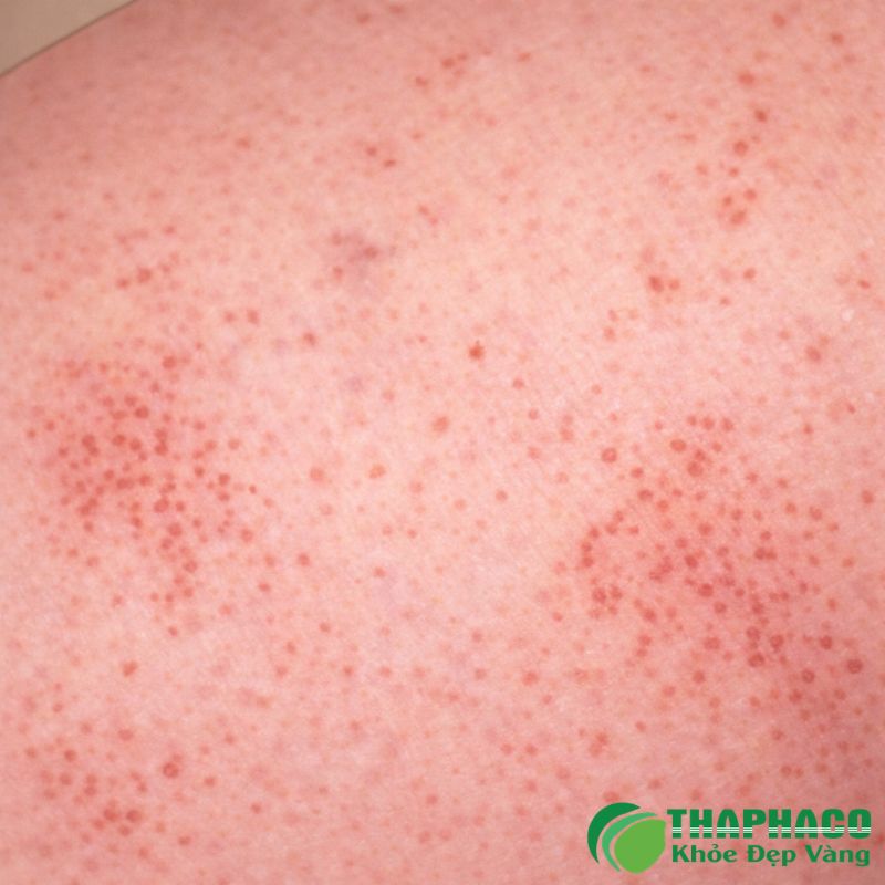 Nguyên Nhân Và Yếu Tố Nguy Cơ Của ITP