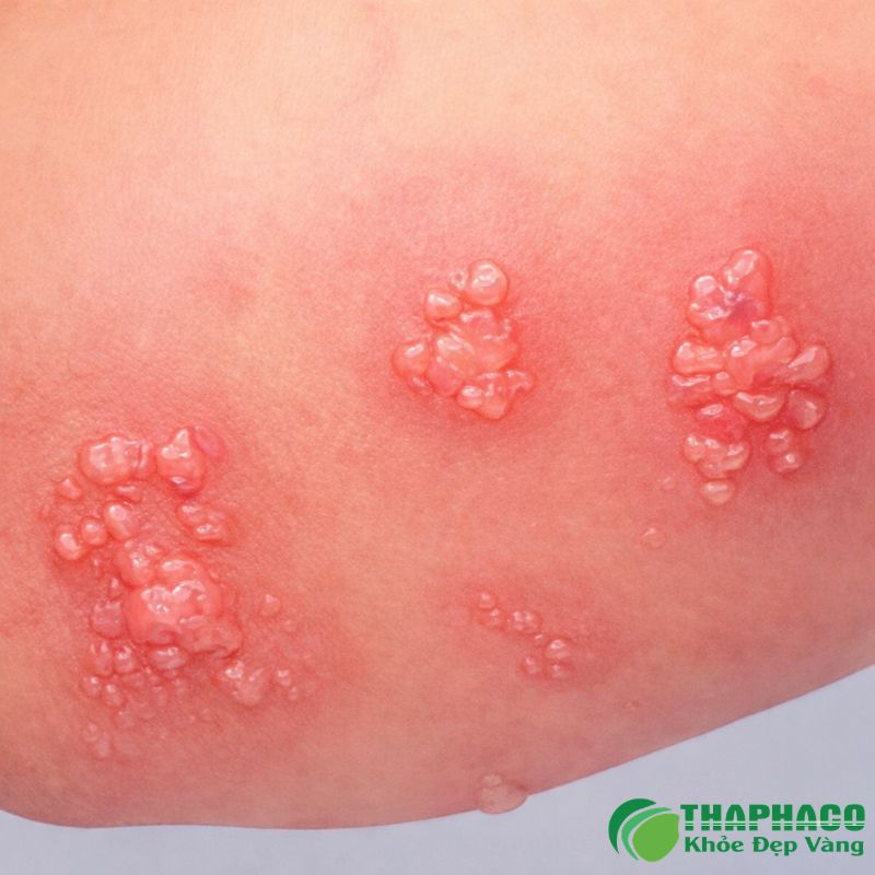 Bệnh Celiac là một rối loạn tự miễn dịch mạn tính của ruột non