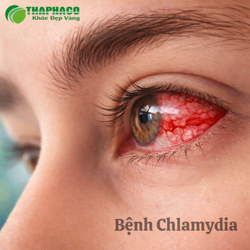 bệnh chlamydia là gì