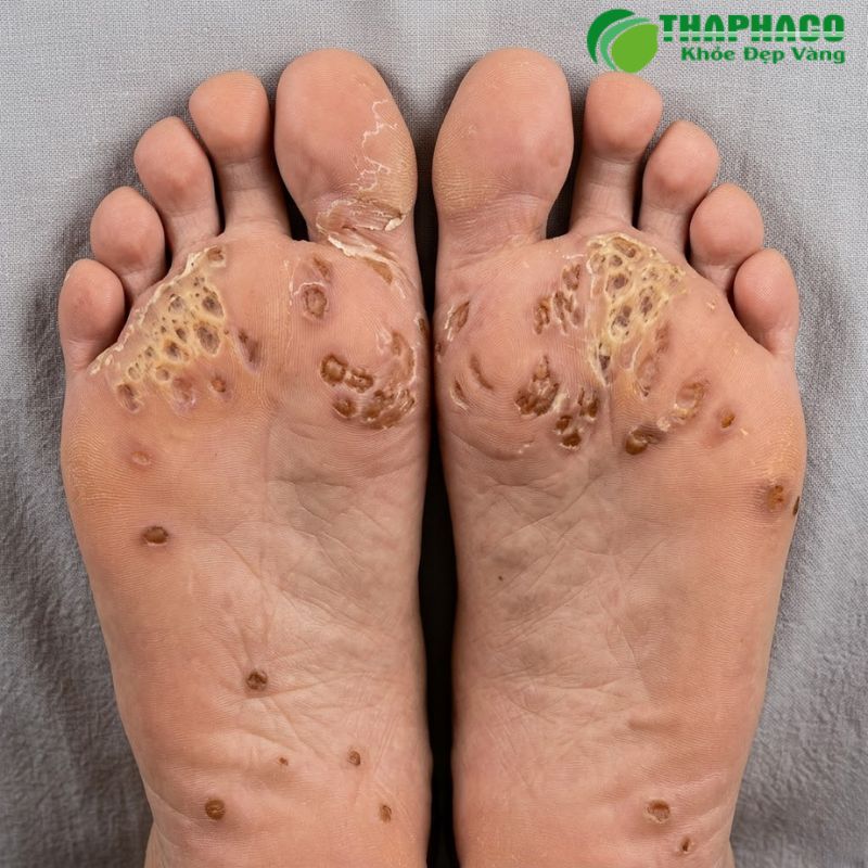 Chlamydia là một bệnh nhiễm trùng lây truyền qua đường tình dục (STI) phổ biến