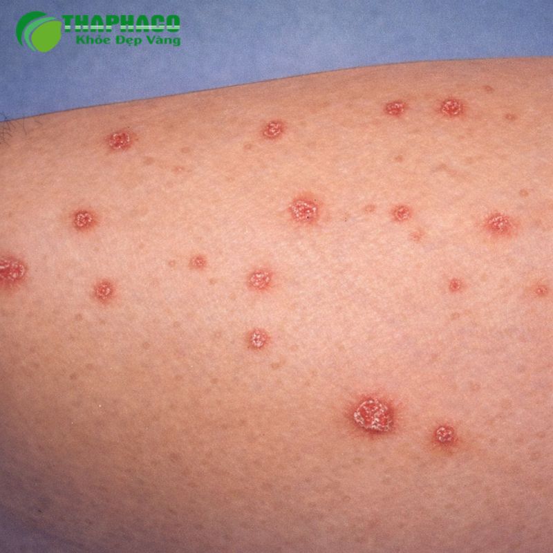 Bệnh lậu là một STI nguy hiểm do vi khuẩn Neisseria gonorrhoeae gây ra