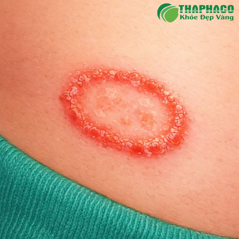 Bệnh chàm (Eczema) là một tình trạng viêm da mãn tính, không lây nhiễm, gây ngứa, mẩn đỏ