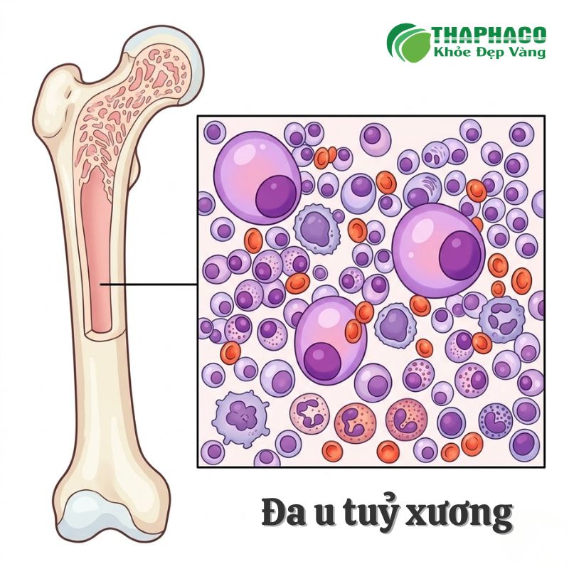 đa u tuỷ xương là bệnh gì
