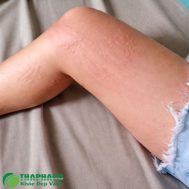 Triệu Chứng Và Nguyên Nhân Gây Dị Ứng Thời Tiết Phổ Biến