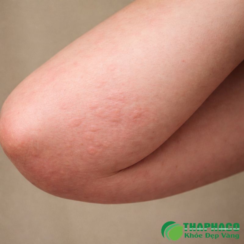 Hỗ Trợ Điều Trị Dị Ứng Thời Tiết Bằng Dược Liệu Sạch Thaphaco