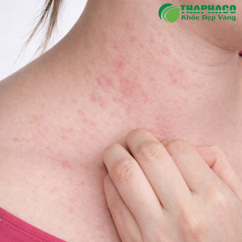 dị ứng thời tiết là gì