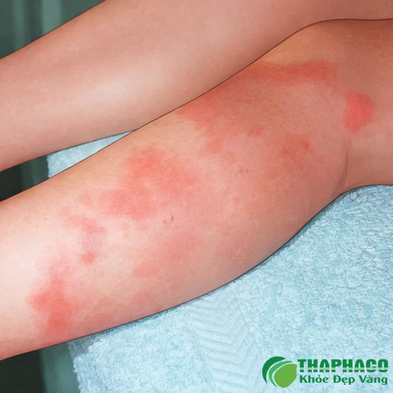Hồng ban đa dạng là một phản ứng viêm cấp tính của da và niêm mạc
