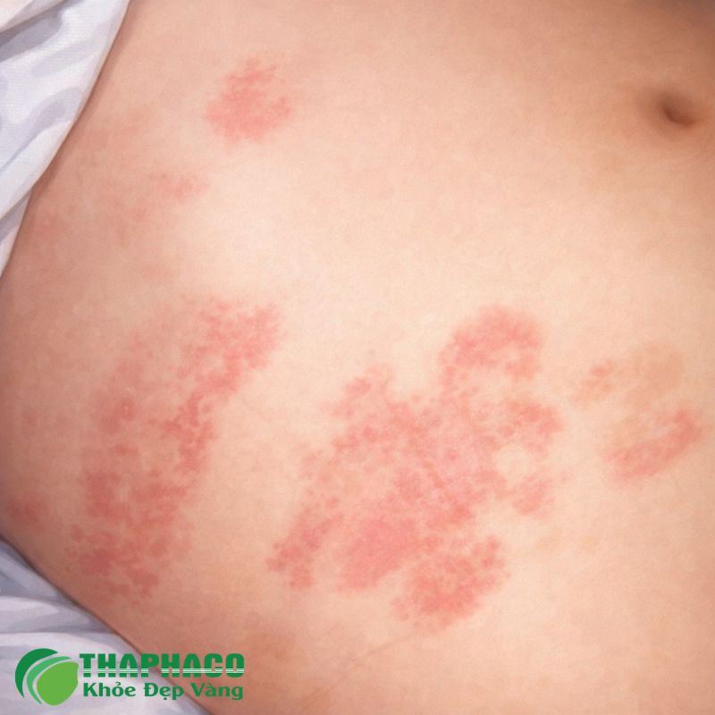lupus ban đỏ hệ thống là gì