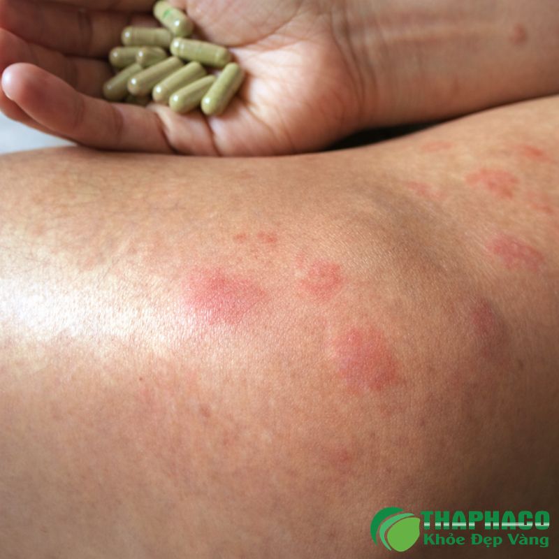 Lupus do thuốc là một phản ứng miễn dịch giống Lupus gây ra bởi một số loại thuốc