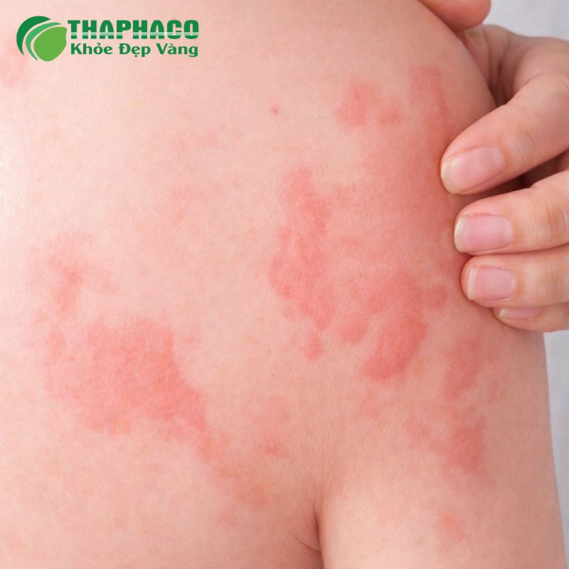 mề đay (cấp và mạn tính) là gì
