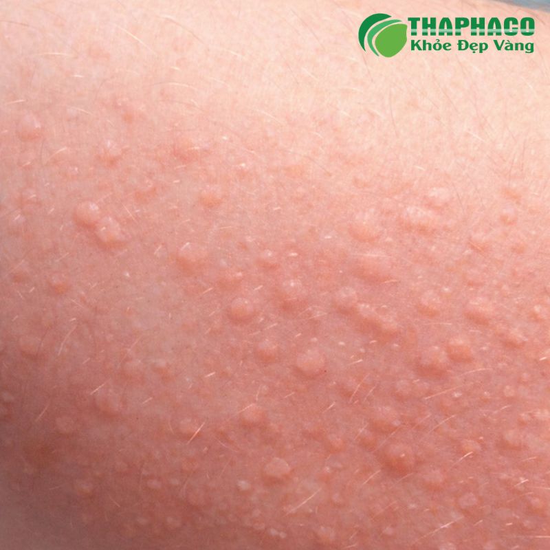 Mề đay mạn tính có thể do nhiều nguyên nhân phức tạp như tự miễn, dị ứng, nhiễm trùng