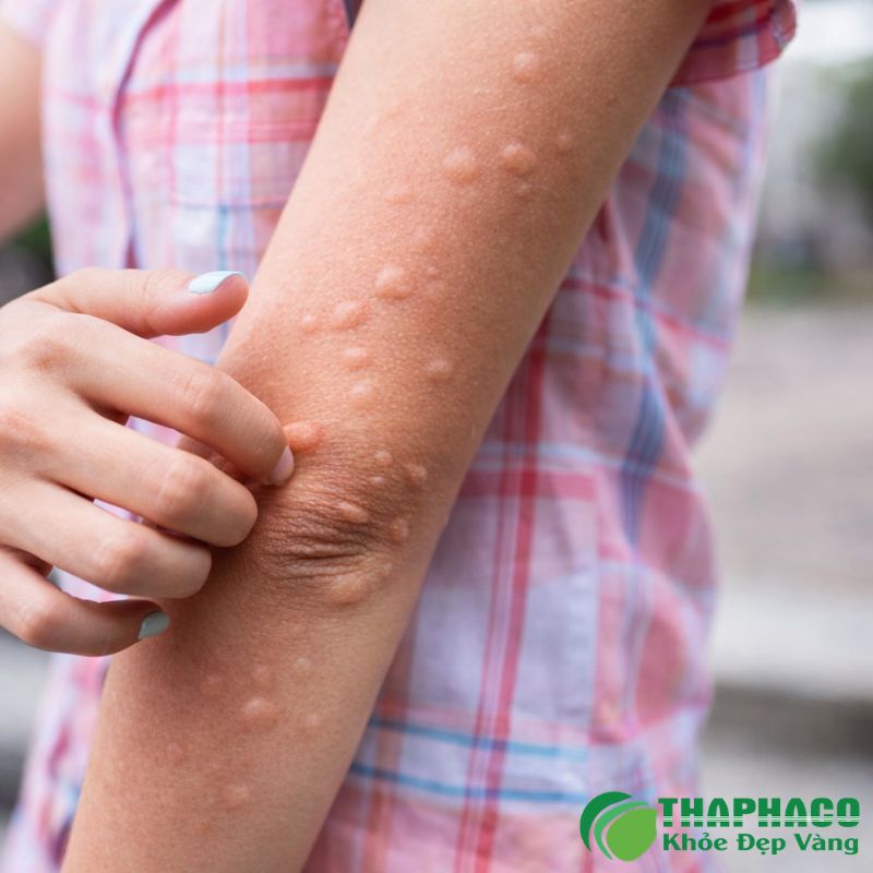 Biến chứng nguy hiểm của mề đay mạn tính