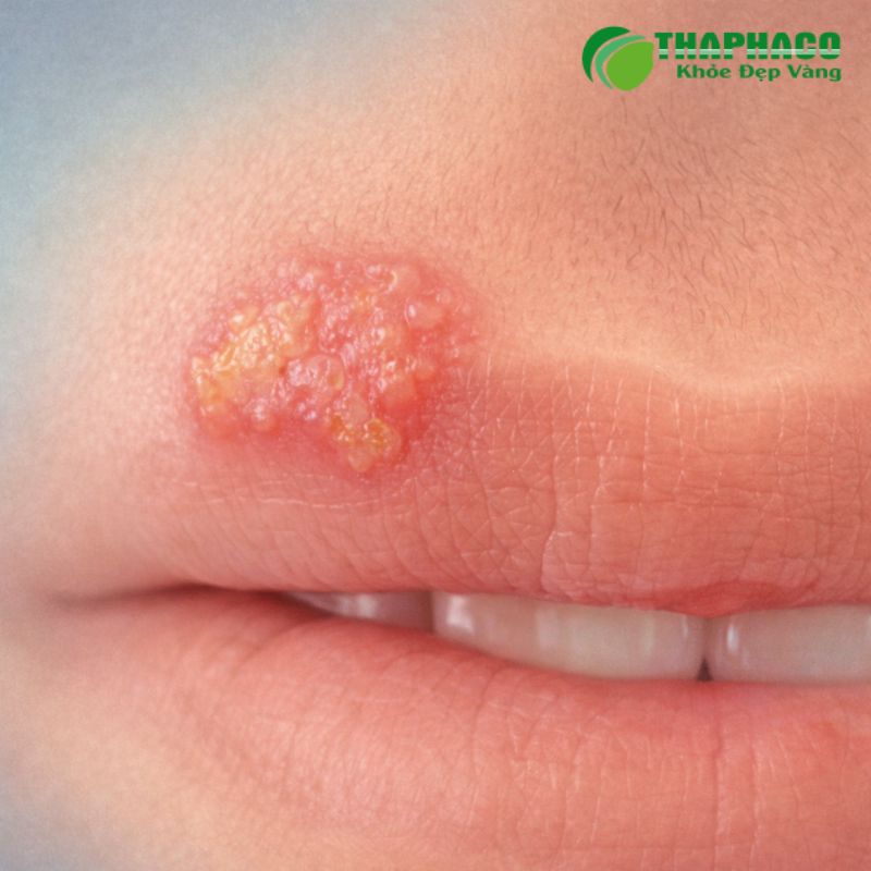 Bệnh mụn rộp sinh dục chủ yếu lây truyền qua quan hệ tình dục không an toàn
