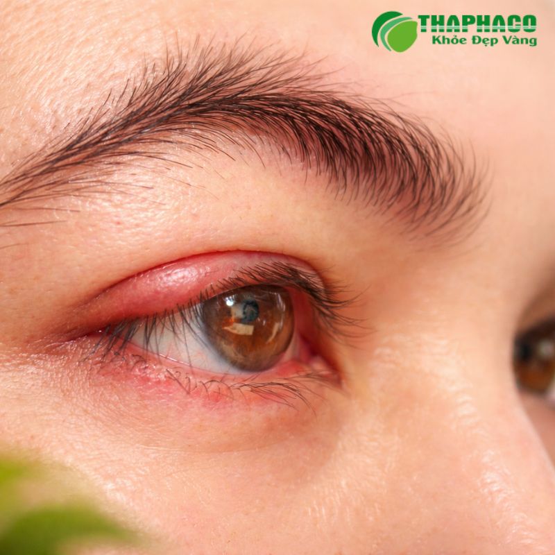 Mụn rộp sinh dục có thể dẫn đến nhiều biến chứng nghiêm trọng như viêm màng não