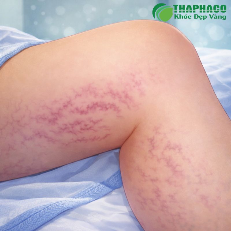 Suy giảm miễn dịch làm tăng nguy cơ nhiễm trùng cơ hội (nấm, lao, virus)