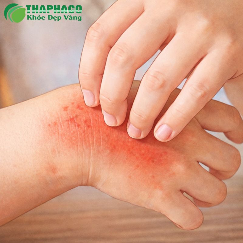 Tái phát là bệnh cũ trở lại do cùng tác nhân, thường liên quan đến điều trị chưa dứt điểm