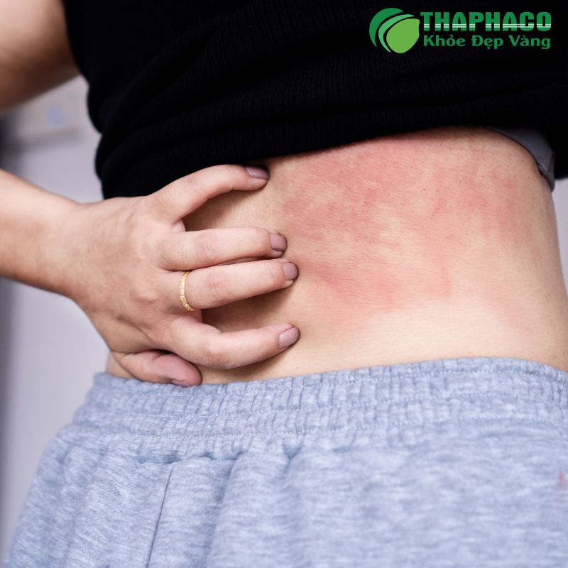 nổi mấn ngứa kéo dài là bệnh gì