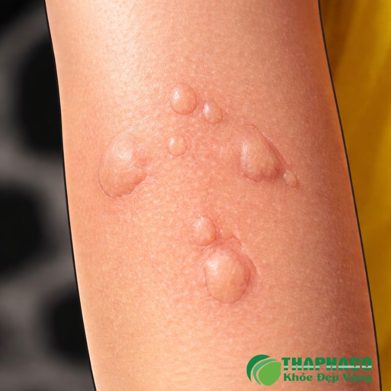 Phong ngứa có thể do nhiều yếu tố từ môi trường, thực phẩm đến bệnh lý bên trong