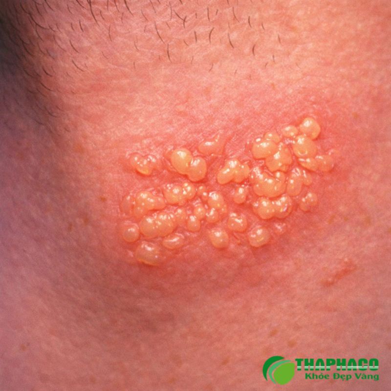 Sùi mào gà là bệnh do virus HPV gây ra, chủ yếu lây truyền qua quan hệ tình dục không an toàn